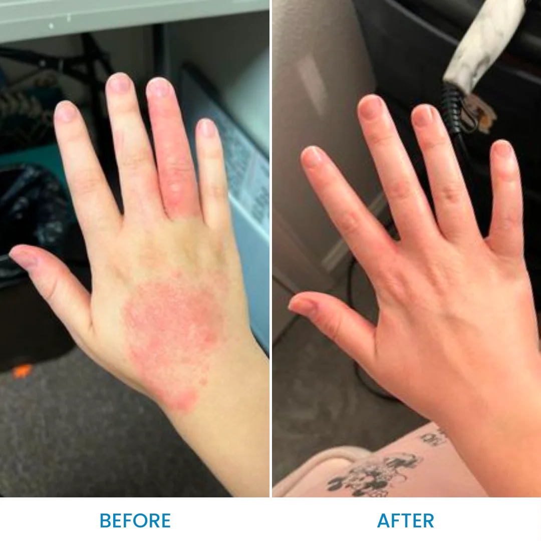 Hand eczema before and after comparison shared by a reader