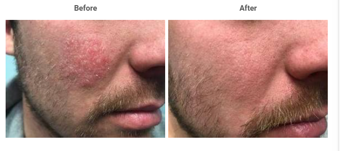 Cheek eczema before and after red light therapy