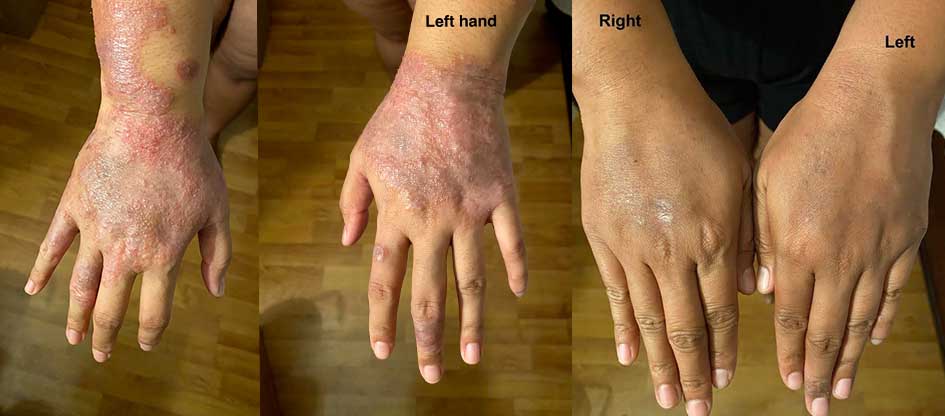 Reader hands after adding red light therapy to their eczema routine