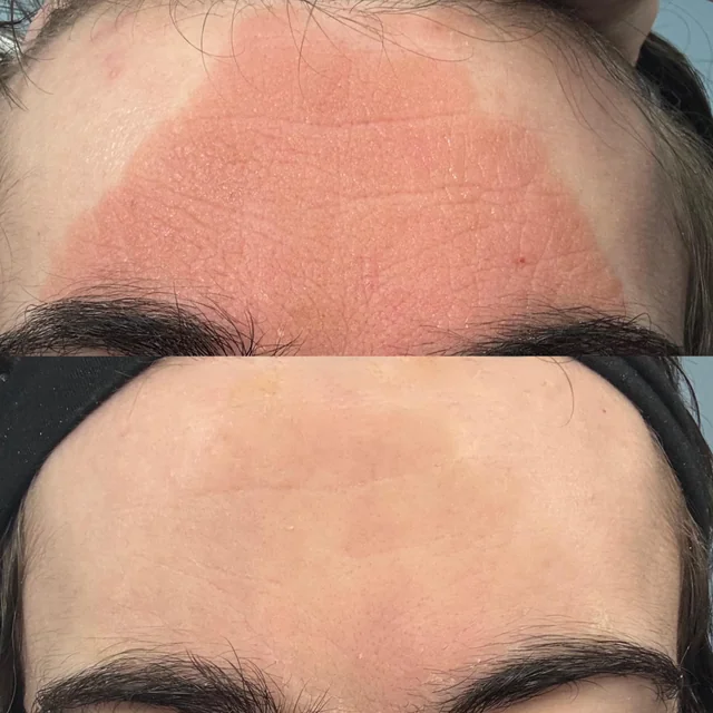 Facial eczema before and after one week of red light therapy