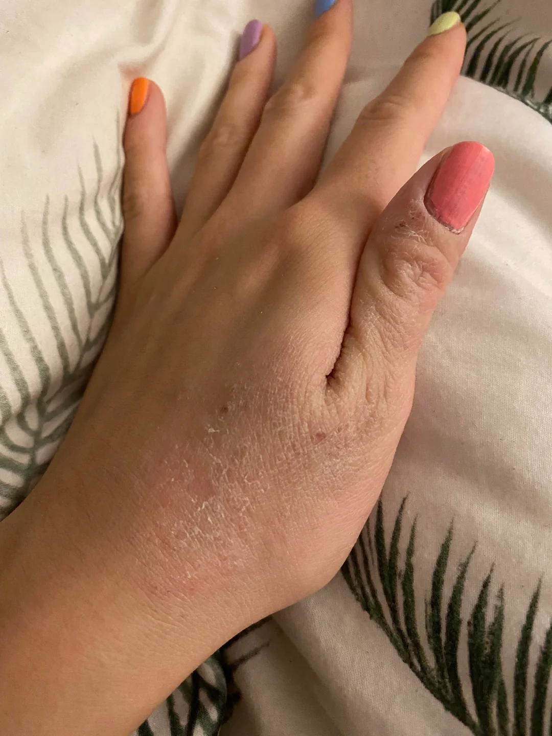 Dyshidrotic hand eczema before and after 3 months of red light therapy