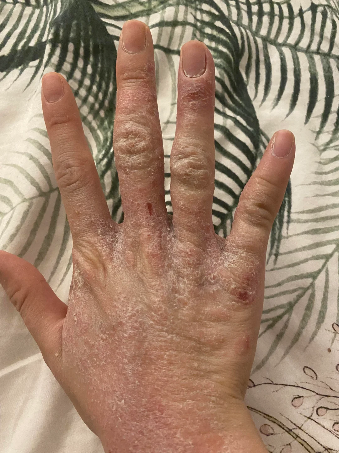 Hand eczema before and after 8 weeks of red light therapy